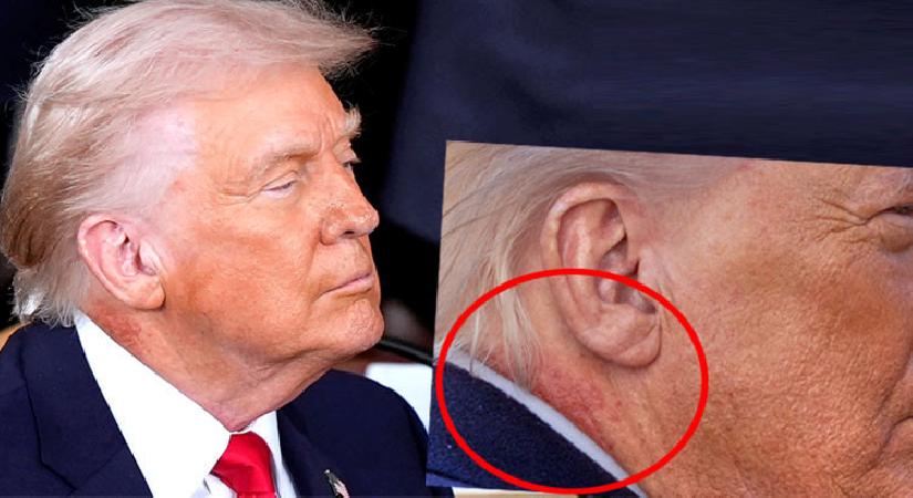 Trump’ın boynuna ne oldu? Kanser tedavisi mi görüyor?