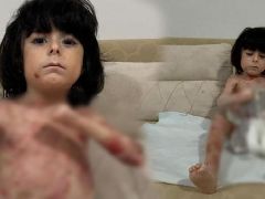 Yaraları tüm vücudunu sardı! 4 yıldır mücadele ediyor: çaresiz durumda