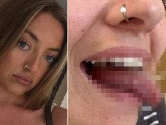 Ağız yarası sanıldı, kanser çıktı! 25 yaşındaki genç bayanın lisanı için kritik ameliyat kararı