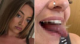 Ağız yarası sanıldı, kanser çıktı! 25 yaşındaki genç bayanın lisanı için kritik ameliyat kararı