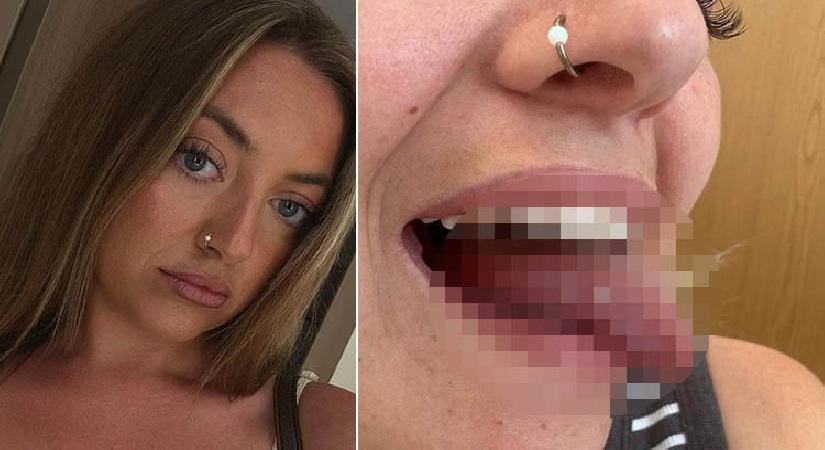 Ağız yarası sanıldı, kanser çıktı! 25 yaşındaki genç bayanın lisanı için kritik ameliyat kararı