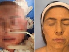 Depresyon ilacı kabusu: Yüzü tanınmaz hale geldi, 66 gün hastanede kaldı