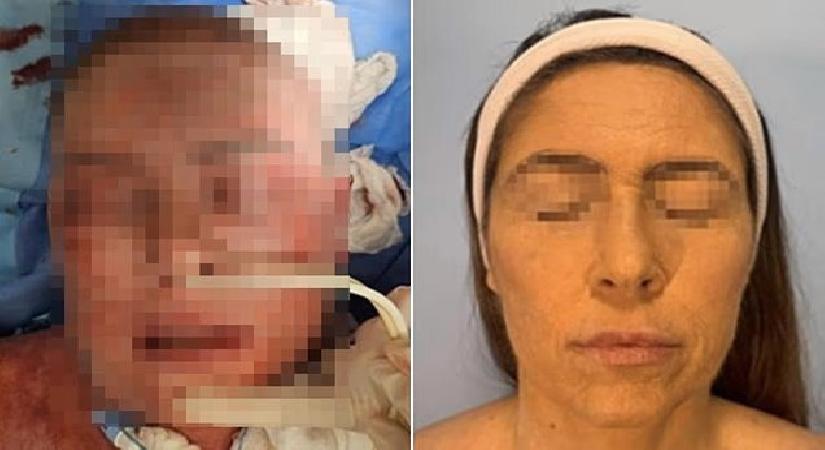 Depresyon ilacı kabusu: Yüzü tanınmaz hale geldi, 66 gün hastanede kaldı