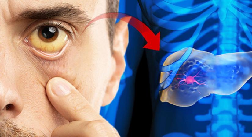Karaciğerin görünmez katili! Çok fazla bilinmiyor, süratle yıkıma sürüklüyor… Bağışıklığınız bu ‘gölge düşmana’ hazır mı?