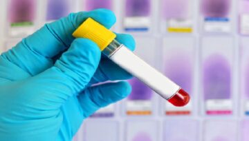 Alzheimer riskini öngören yeni bir kan testi yolda! Tam olarak ne vakit hazır olacak?