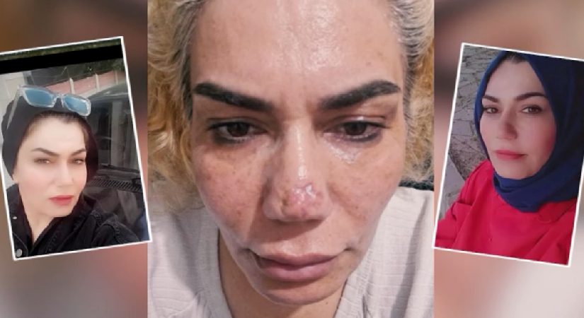 Estetik ameliyatında burnu bu hale geldi, hekimden şikayetçi oldu