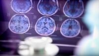 Sinsi hastalık, birinci belirtiden 20 yıl evvel başlıyor! Bu kusurlar Alzheimer’a taban hazırlıyor