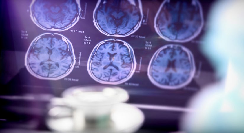 Sinsi hastalık, birinci belirtiden 20 yıl evvel başlıyor! Bu kusurlar Alzheimer’a taban hazırlıyor