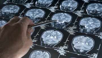 Alzheimer’da gençlik proteini keşfi