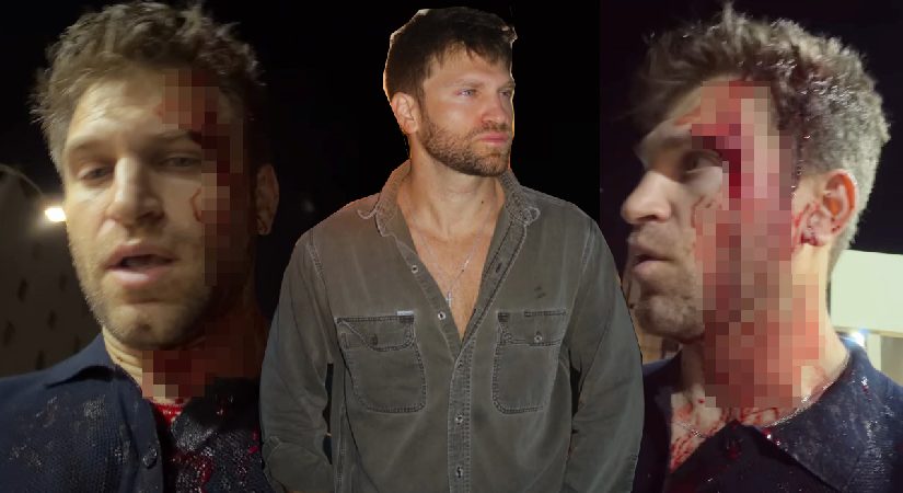 Pretty Little Liars yıldızı Keegan Allen akına uğradı. Kanlar içinde olayı anlattı